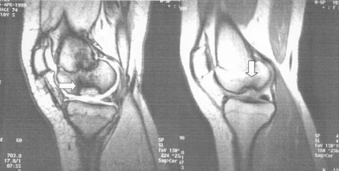 X-ray of dissecting osteochondrosis in the knee joint
