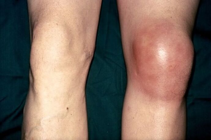 healthy, swollen knee in pain
