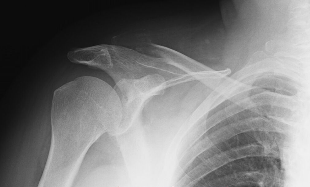 x-ray for osteoarthritis of the shoulder