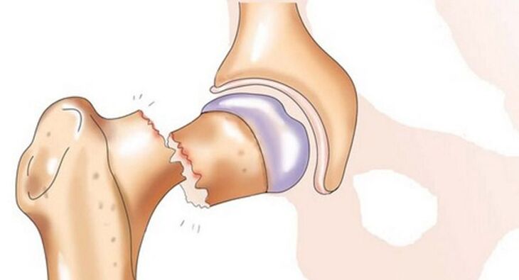 A femoral neck fracture is accompanied by severe pain in the hip joint