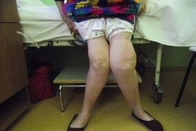 Advanced osteoarthritis of the knee joint