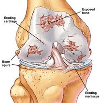The mechanism of arthrosis development